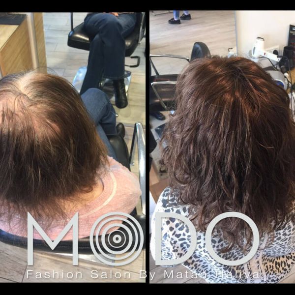 מילוי שיער דליל