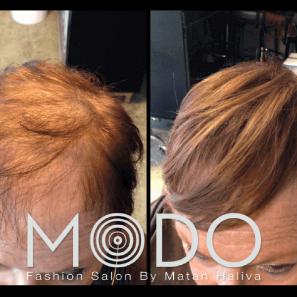 מילוי שיער דליל לפני ואחרי